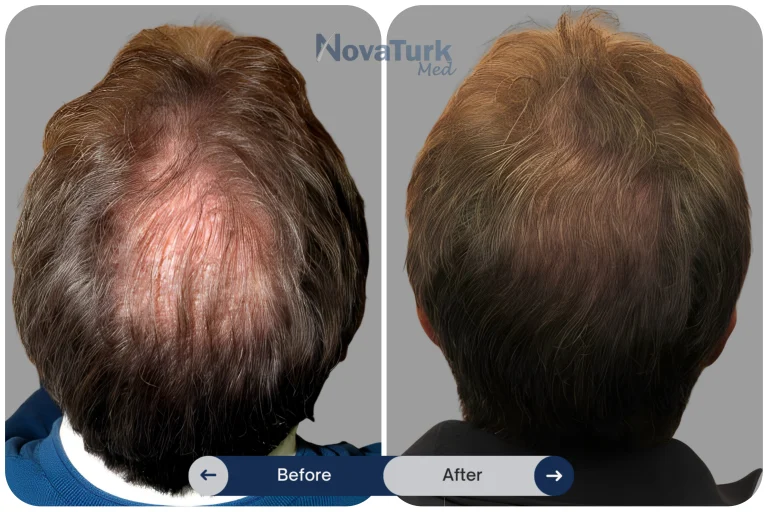 The Complete Guide to Crown Hair Transplants